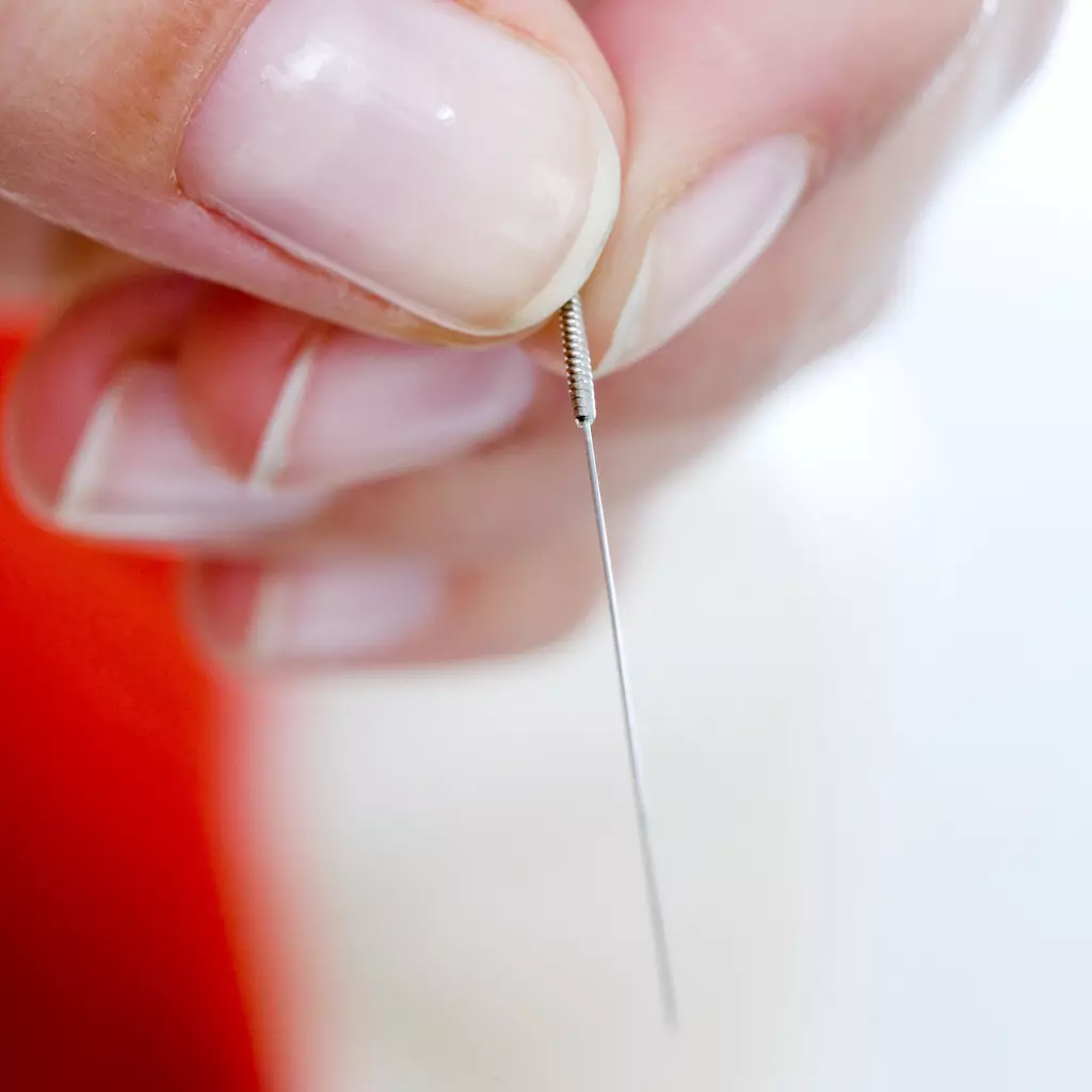 CPDG treating trigger points with acupuncture