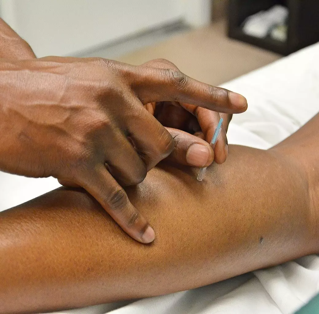 CPDG trigger pt vs acupuncture pt