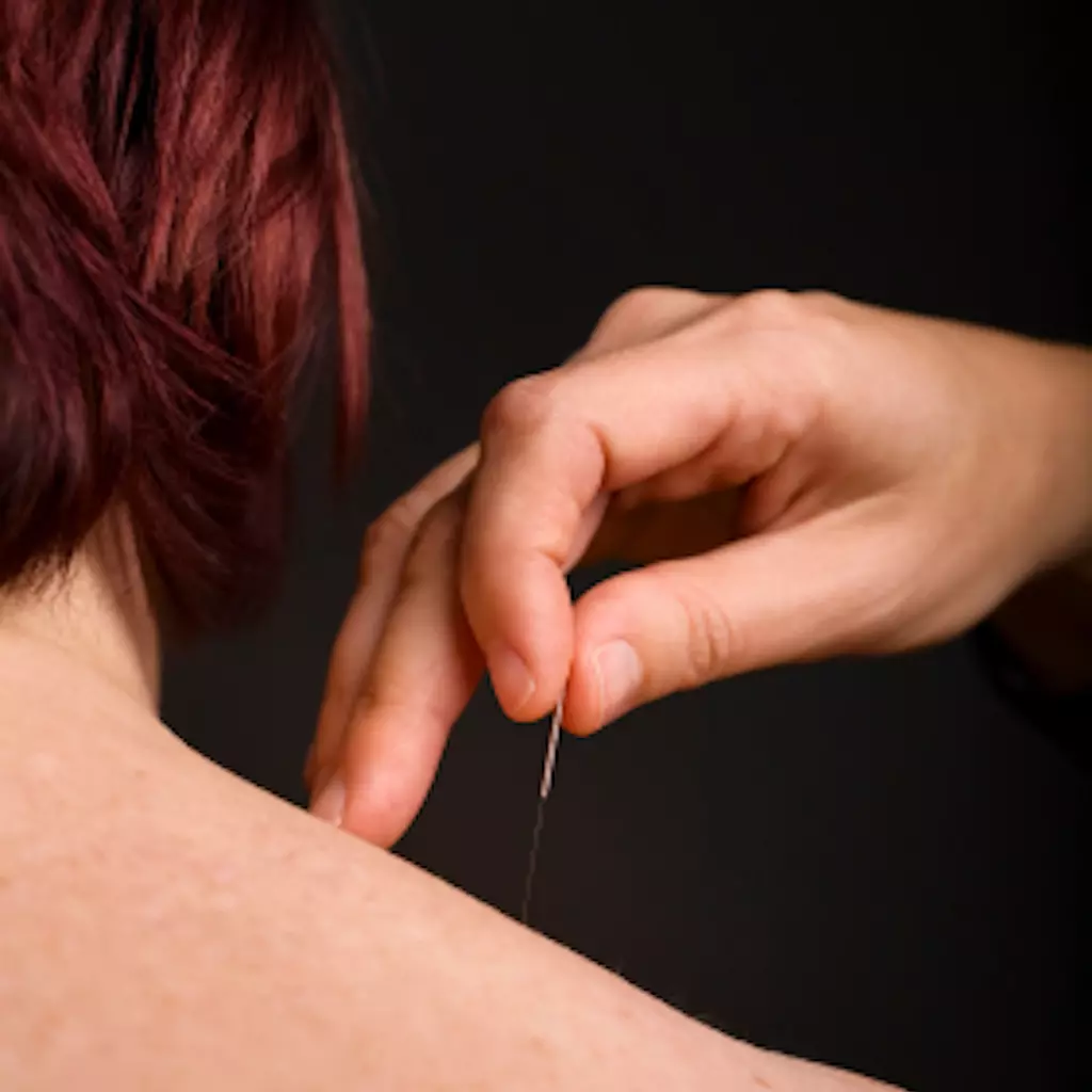 CPDG trigger point current practice