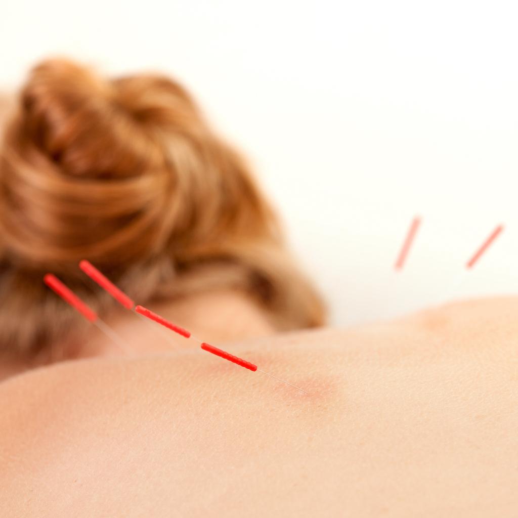 CPDG trigger point theory